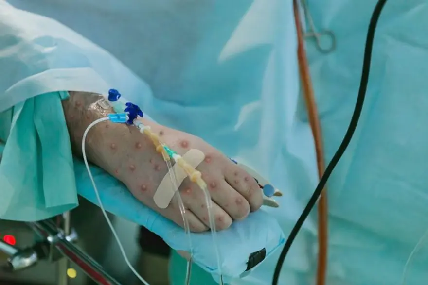 5) MAYMUN ÇİÇEĞİ NASIL BULAŞIR? 6