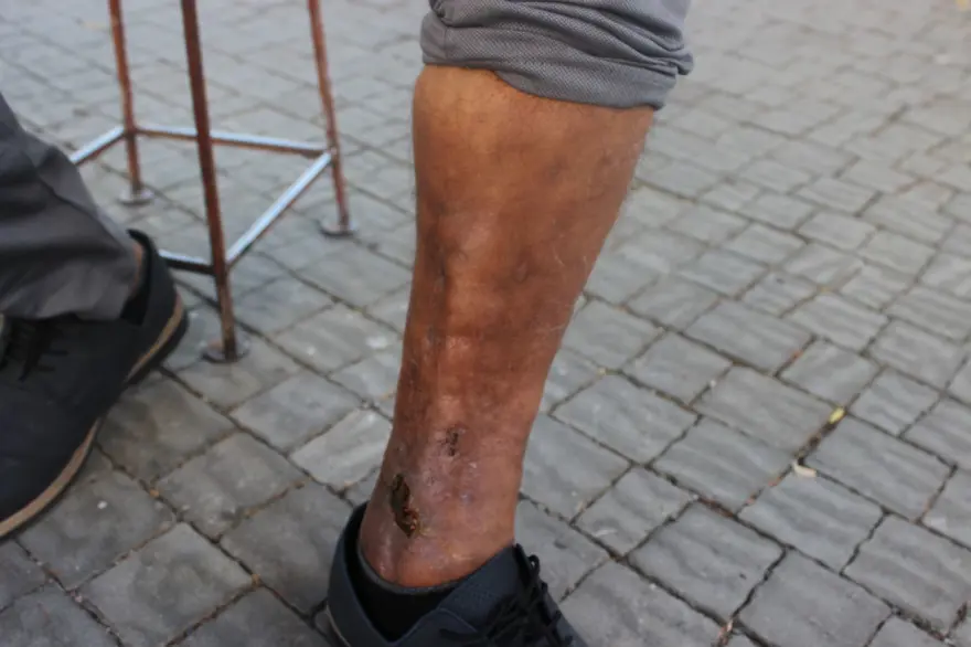 Sülük tedavisi hayatını kararttı! 2 aydır işe gidemiyor, yürümekte güçlük çekiyor 5