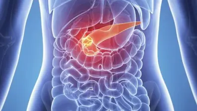 “Pankreas kanseri en sinsi kanser türü”