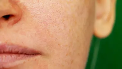 Tıkalı gözenekler nasıl açılır? Bu yöntem ciltteki ölü deriyi temizliyor