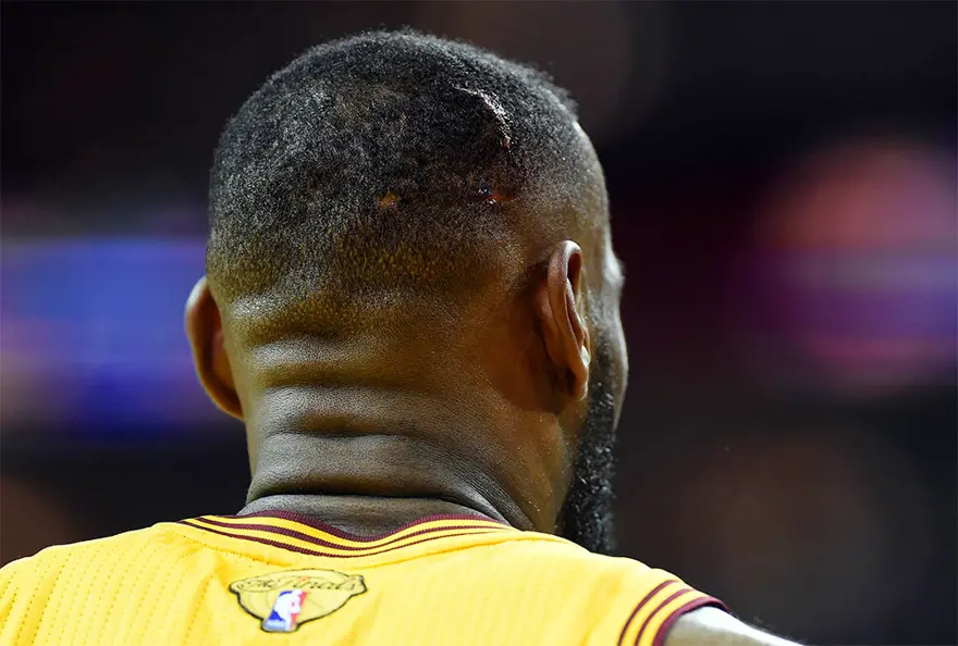 LeBron James'in kafası yarıldı 3