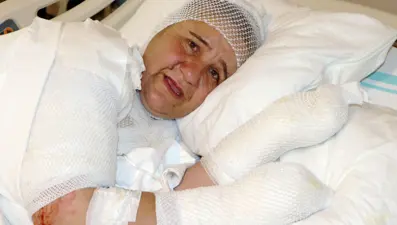 Ekmek pişirirken tandıra düştü