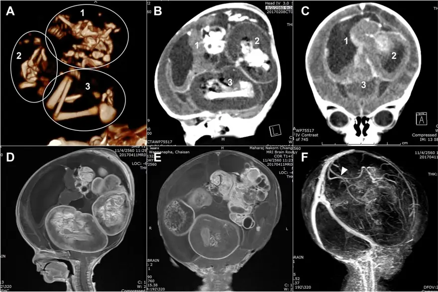 FETÜS İÇİNDE FETÜS NEDİR? 3