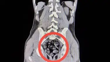 Kars'ta operasyon: İranlı kuryenin makatından uyuşturucu çıktı