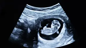 Dünyada yalnızca 200 vaka var: Kardeşlerini karnında taşıdı Dünyada yalnızca 200 vaka var: Kardeşlerini karnında taşıdı