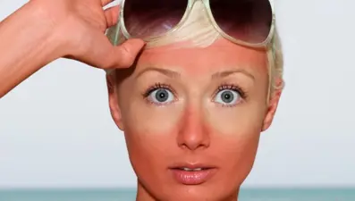 Yaz sonu ve sonbahar başında güneş alerjisine dikkat