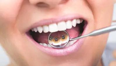 Güzel gülüşlerin sırrı koruyucu ortodonti olabilir!