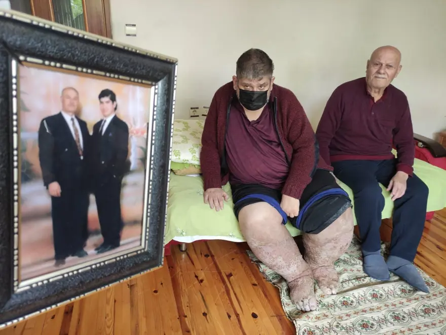 Sivrisinek ısırığı hayatını kararttı Sivrisinek ısırığı hayatını kararttı