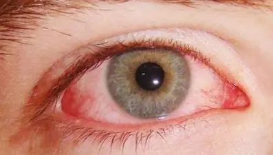 Göz kızarıklığına ne iyi gelir? Göz kızarıklığı nasıl geçer ve neden olur?