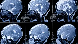 Yenidoğanlarda beyin hasarı erken tespit edilebilecek