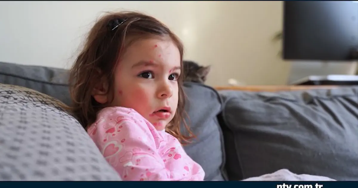 Dikkat, İstanbul'da kızamık vakalarında artış