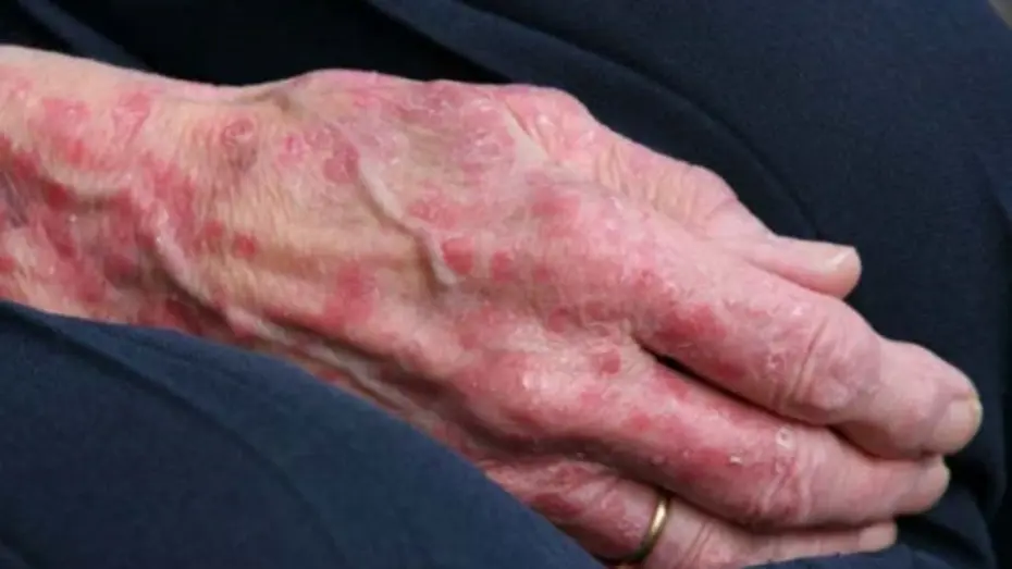 Romanya ve Hırvatistan'da cüzzam vakaları görüldü. 40 yıl sonra ilk 