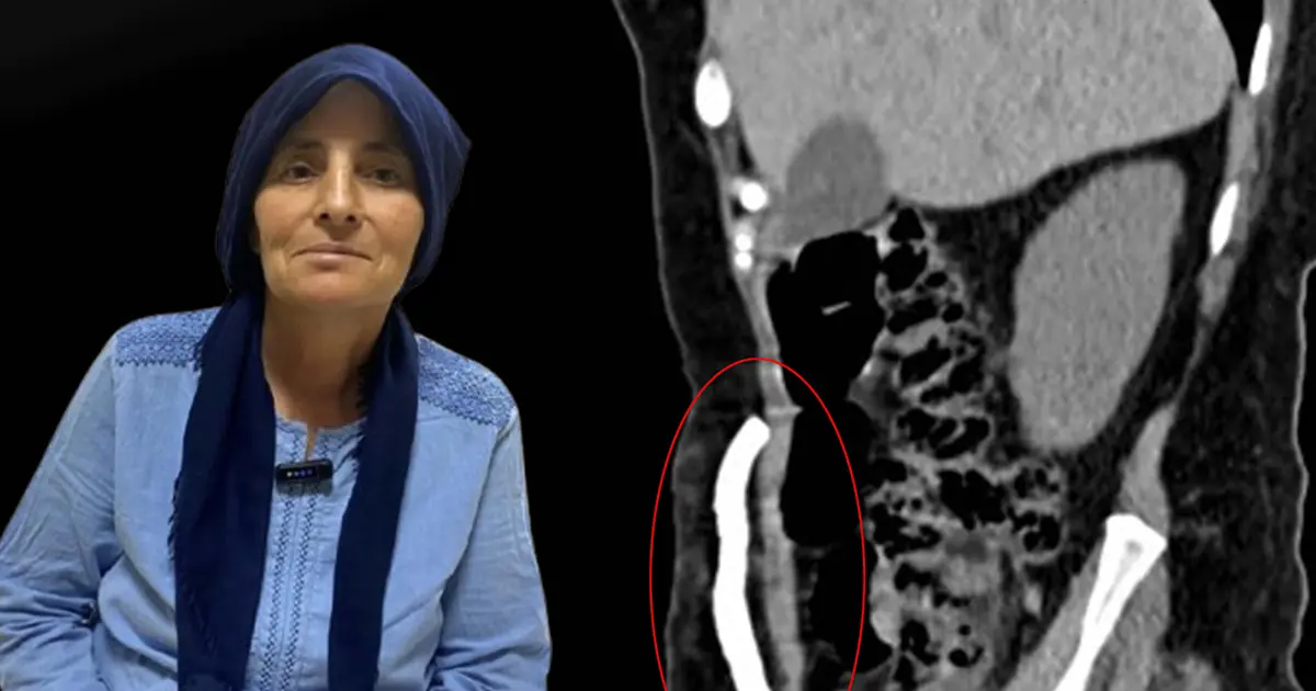Manisa'da bir ilk. Karın boşluğunda aylarca kafatası kemiği taşıdı, sağlığına kavuştu
