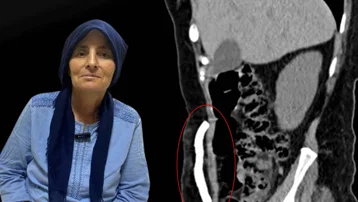 Manisa'da bir ilk. Karın boşluğunda aylarca kafatası kemiği taşıdı, sağlığına kavuştu