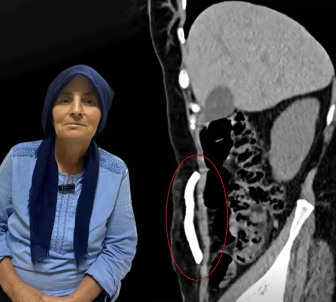 Manisa'da bir ilk. Karın boşluğunda aylarca kafatası kemiği taşıdı, sağlığına kavuştuManisa'da üç çocuk annesi Iraz Yavaş, karın boşluğunda 8 ay taşıdığı kafatası kemiğinin yeniden anatomik yerine yerleştirilmesiyle sağlığına kavuştu.