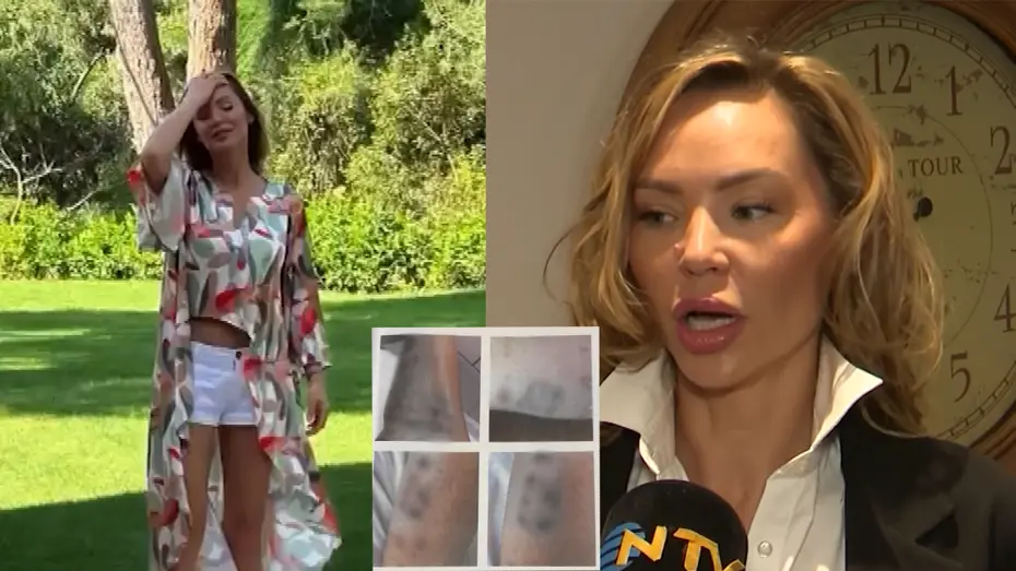 Şişli'de estetik yaptırmak isteyen mankenin vücudu yandı. Dizilerde oynuyordu, işinden oldu