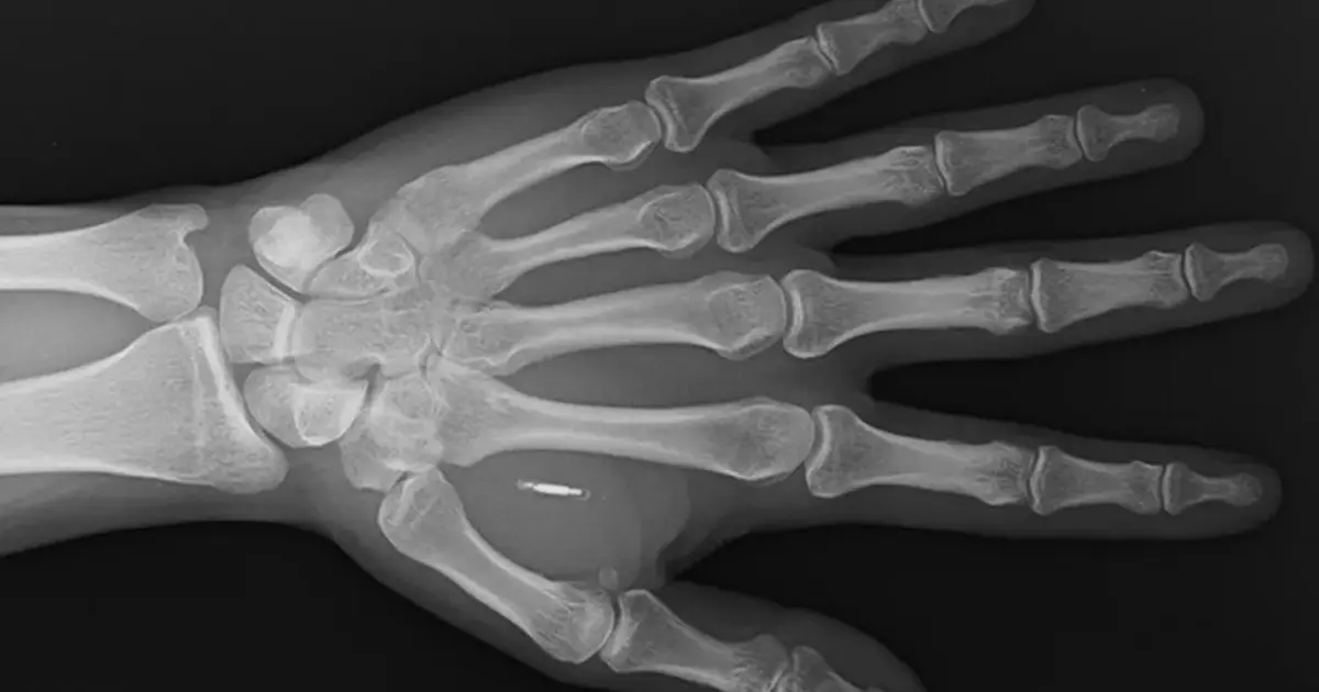 Eline yerleştirilen mikroçip röntgen görüntüsü