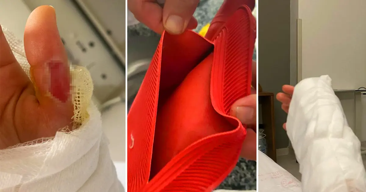 Sıcak su torbası patladı, vücudunun yüzde 25'i yandı