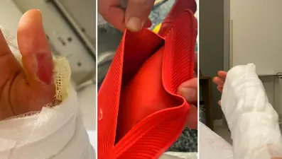 Sıcak su torbası patladı, vücudunun yüzde 25'i yandı